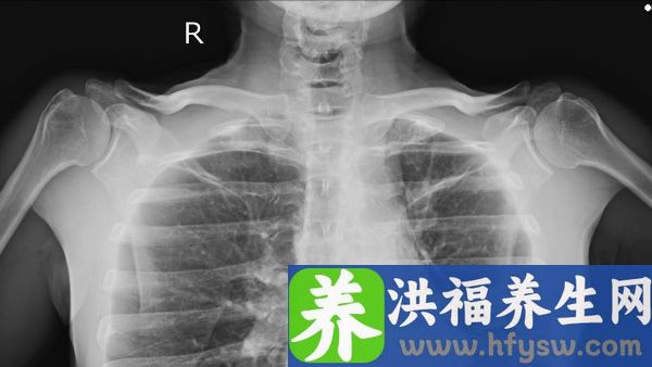 肺结核的并发症有哪四种
