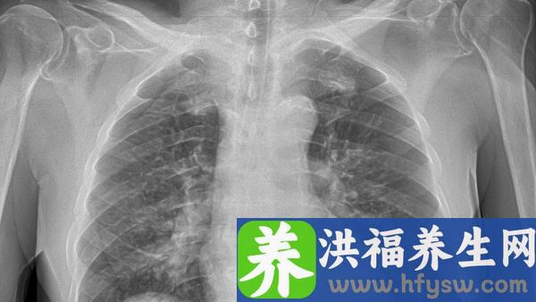 肺性脑病有哪些表现