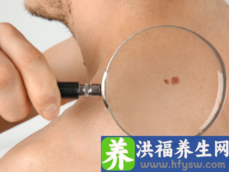 宝宝面部出现灰色色斑有可能是太田痣引起，目前其原因尚不明确