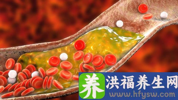 高密度胆固醇偏低怎么回事怎么办