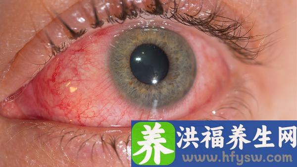 咽结膜炎怎么治疗效果好呢
