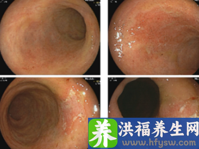 60岁男性因溃疡性结肠炎引起结肠癌，经手术临床治愈