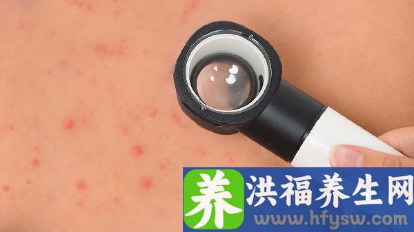 春季过敏鼻子不通气怎么办