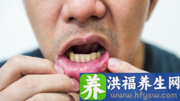 牙龈上火吃什么食物好的快