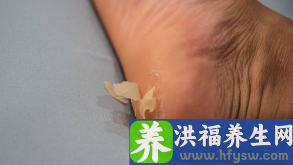 脚气病的症状