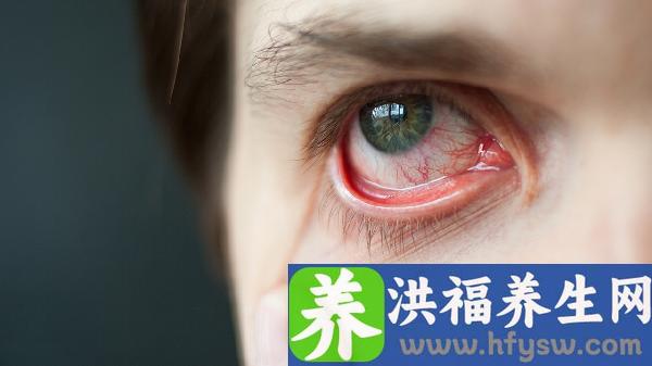 病毒性角膜炎反复发作怎么能治好