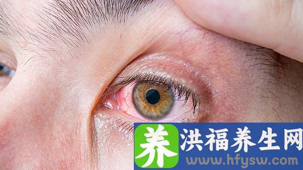 干眼症的诊断依据四个方面