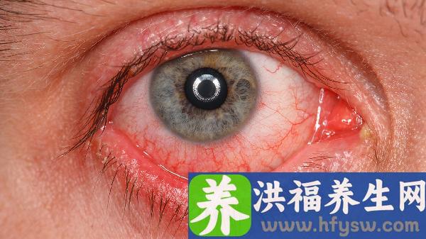 春季结膜炎的分泌物是什么颜色