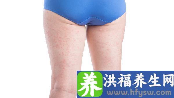 大腿内侧吸脂手术失败后的修复方法