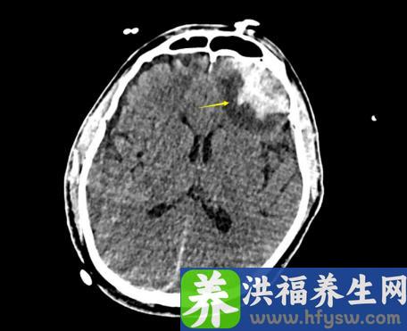 参展外商突发心跳骤停，多学科医生接力救治转危为安