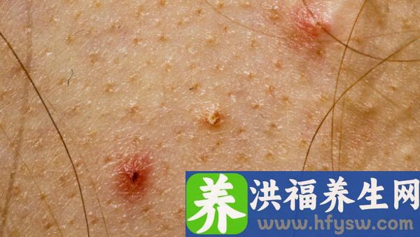 结节性红斑是免疫系统疾病吗