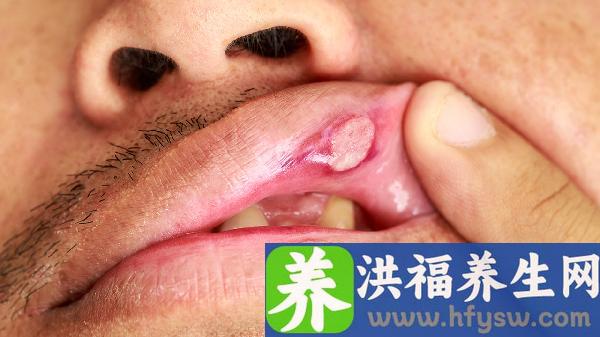 鼻孔里有血但是没流血是不是上火