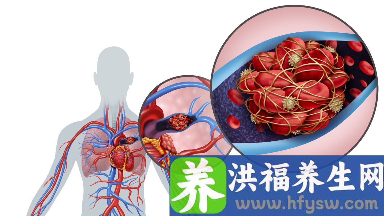 肺栓塞症状有哪些