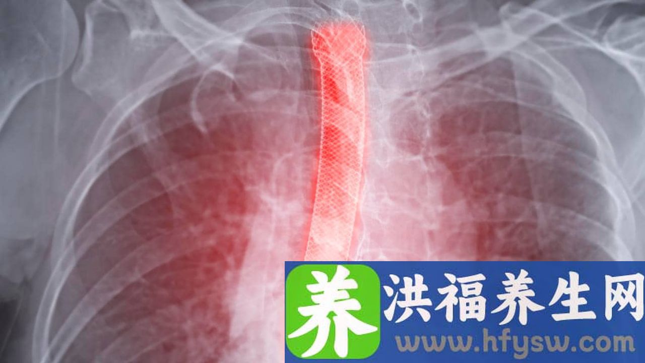 慢性食管炎能治根吗