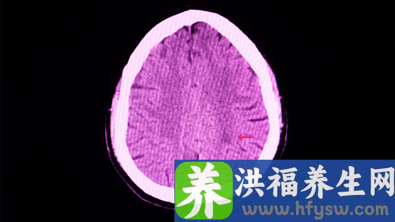 脑梗后脚浮肿怎么办