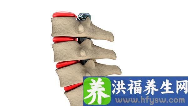 强直性脊柱炎的患者可以跑步吗