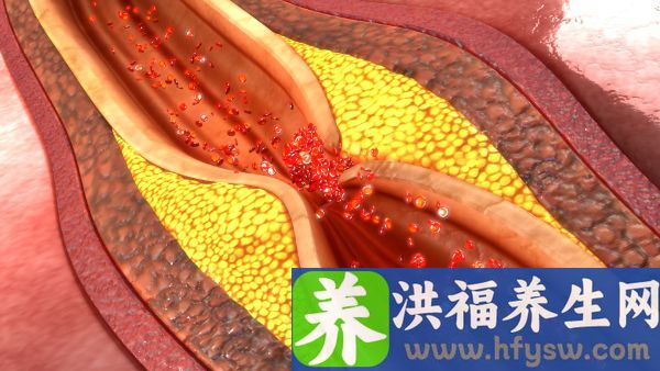 动脉导管未闭的临床表现有哪些