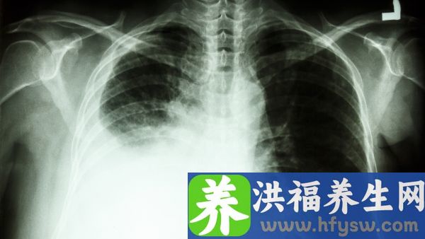 支原体肺炎输液后咳嗽加重
