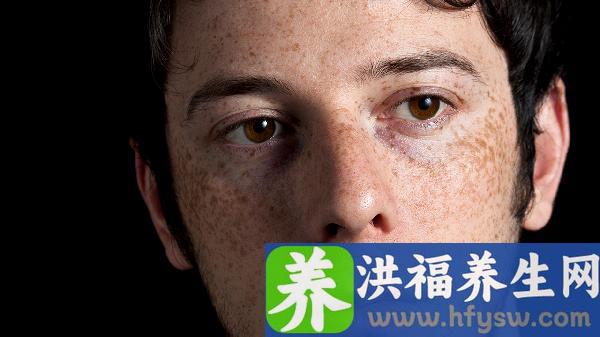 男性早期红斑狼疮能治好吗