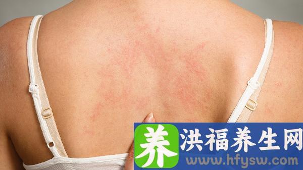 长了汗疱疹不可以吃什么食物