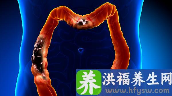 肠炎一直不好会癌变吗