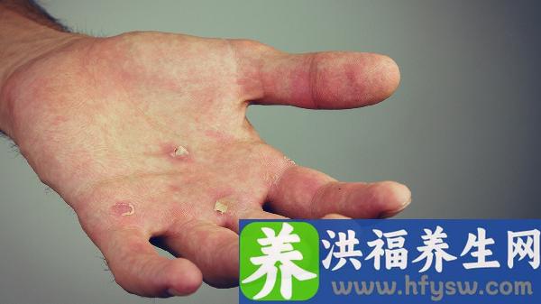 并指畸形免植皮矫正要多久