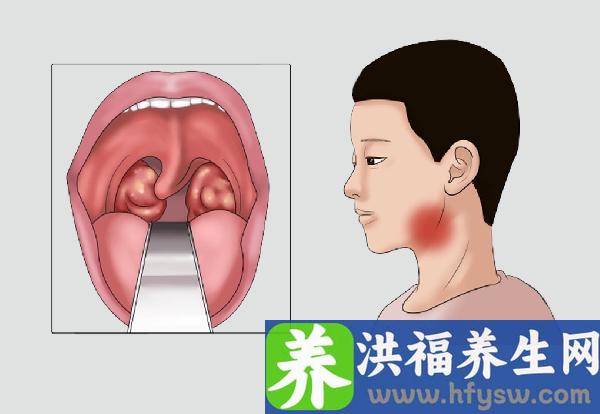 扁桃体淋巴瘤的早期症状是什么