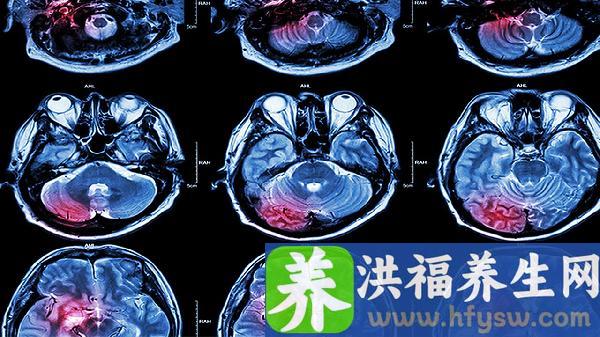 脑梗死失语症治疗方法