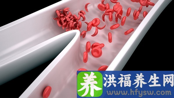 缺铁性贫血，会导致耳鸣吗