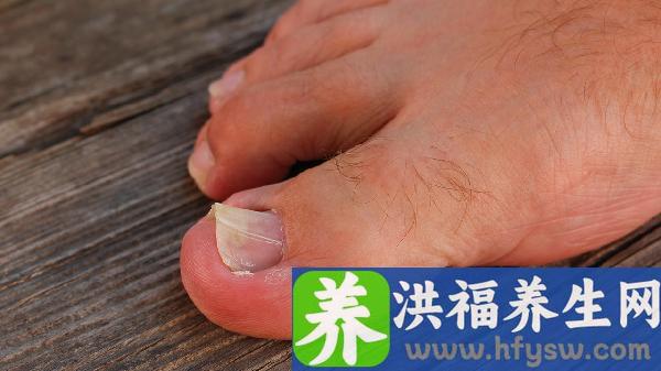 嵌甲甲沟炎怎么消肿快一点