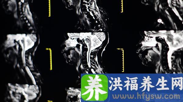 颈动脉斑块吃什么药