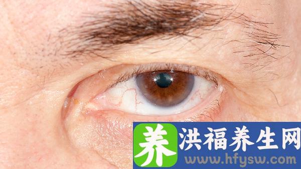 飞蚊症是玻璃体浑浊引起的吗