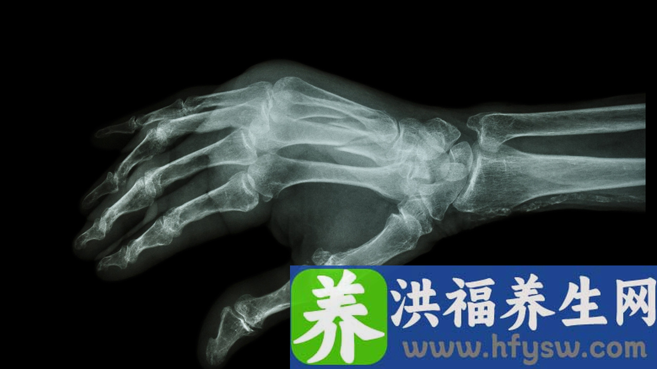 掌骨骨折多久拆钢板