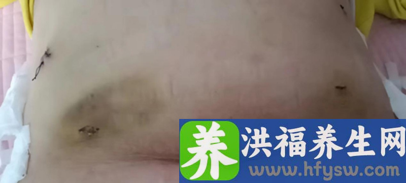 一台早期胃癌手术仅留有5个“钥匙孔”，这个团队做到了！