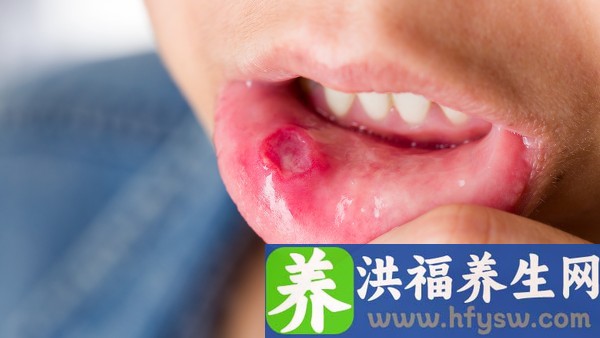 上火下寒是什么症状,该怎么解决 二陈丸可以跟小柴胡颗粒一起吃吗