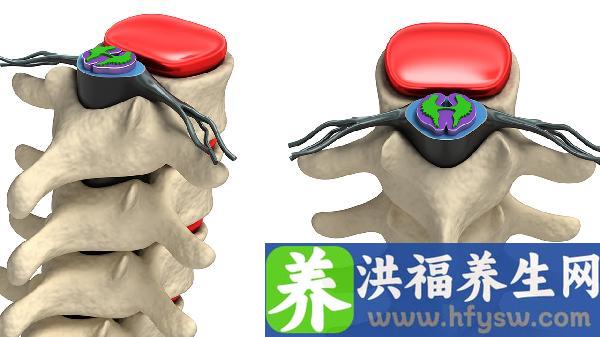 颈椎黄韧带增厚椎管狭窄怎么样治疗好